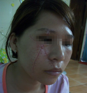 Nạn nhân sau 15 ngày điều trị