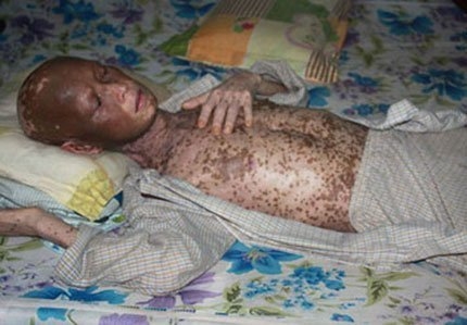 Bệnh nhân Văn Viết Điền (42 tuổi, Bình Phước) nhiễm giun lươn Strongyloides Stercoralis