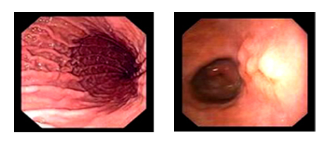 hình ảnh dạ dày bình thường hình ảnh viêm niêm mạc dạ dày qua nội soi