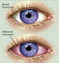 Bệnh đau mắt đỏ cần được điều trị kịp thời (Ảnh minh họa)