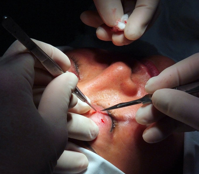   Phẫu thuật cắt mí mắt - Ảnh: BS Lê Hành cung cấp