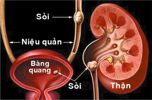 Các vị trí thường gặp sỏi ở hệ tiết niệu.