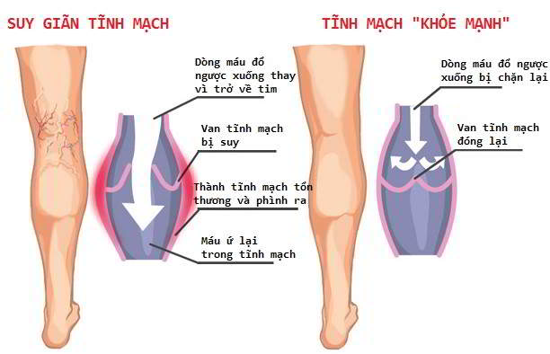 Suy giãn tĩnh mạch là nguyên nhân dẫn đến tình trạng viêm tắc tĩnh mạch chi.
