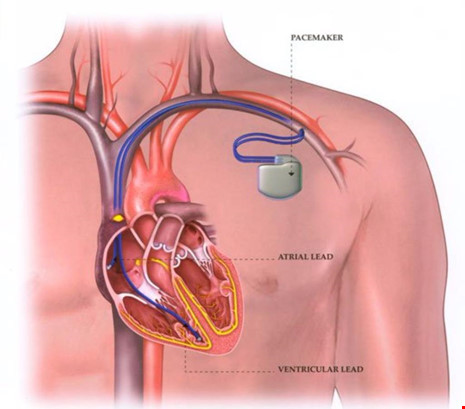 Máy tạo nhịp tim mini sẽ thay đổi máy tạo nhịp tim truyền thống vốn cồng kềnh và dây dẫn truyền dễ gây nhiễm trùng. Hình minh họa.