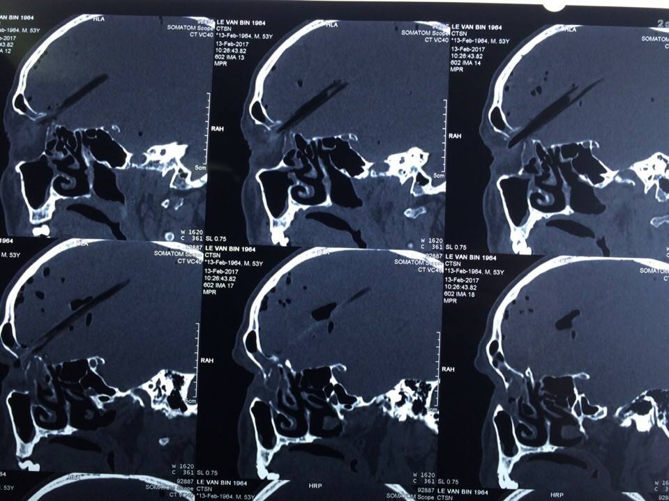 Hình chụp Xquang của bệnh nhân bị cành cây đâm xuyên từ mắt lên nền sọ não.
