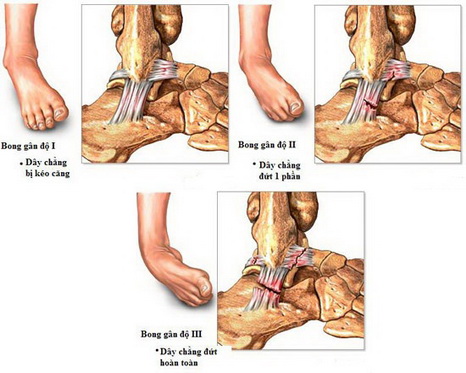 Các mức độ khi bị bong gân cổ chân.