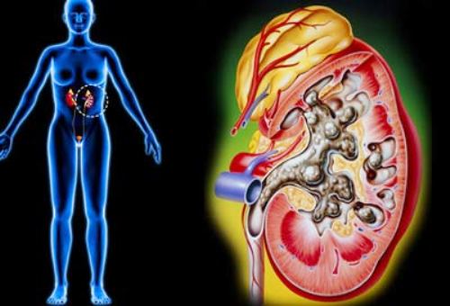 Ảnh mô phỏng một trường hợp bé trai mắc viêm cầu thận cấp hậu nhiễm liên cầu trùng. Ảnh: edoctor.