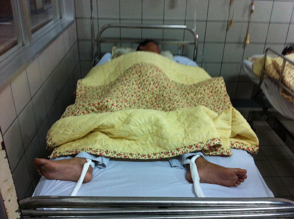 Bệnh nhân xơ gan do rượu điều trị tại BV Bạch Mai.