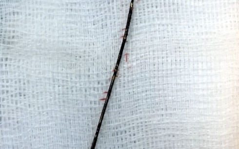 Cây kim khâu được lấy ra từ bệnh nhân nhi