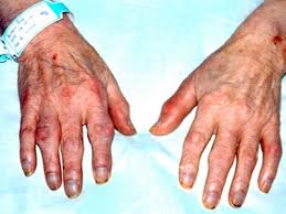 Hình ảnh bàn tay bị biến chứng do bệnh đái tháo đường (ảnh Internet).