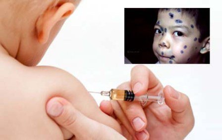 Các chuyên gia y tế khuyến cáo cha mẹ cần tiêm vắc xin đầy đủ để phòng ngừa dịch bệnh, trong đó có dịch bệnh thủy đậu cho trẻ