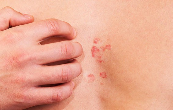 Cảm giác ngứa ngáy đi kèm với mẩn đỏ có thể là biểu hiện của dị ứng thực phẩm.