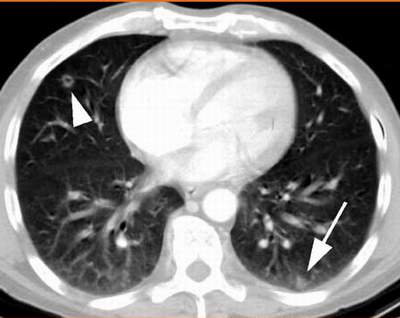 Tổn thương phổi do nấm trên phim chụp cắt lớp.