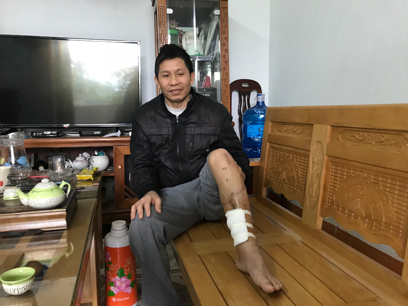 Do vết thương khá nặng nên hiện nay, dù đã qua 6 tháng điều trị, chân ông Chủng vẫn rò rỉ nước vàng.