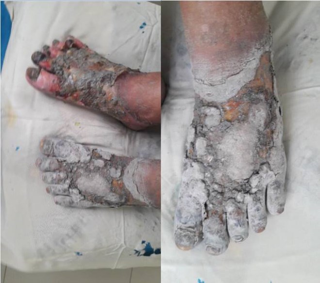 Hai bàn chân bị bỏng nặng của Bệnh nhân Nguyễn Văn D. do tự ý ngâm chân bằng nước nóng với nhiệt độ cao. (Ảnh: PV/Vietnam+)