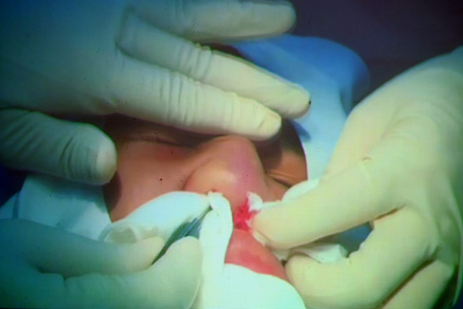 Bác sĩ xử lý ổ nhiễm trùng vùng mũi của cô gái sau tai nạn 