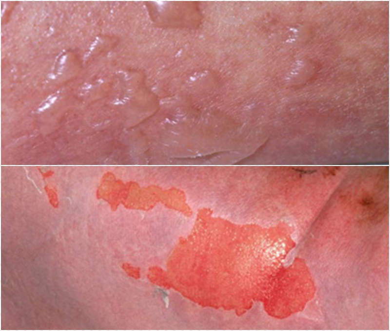 Hội chứng Lyell do dị ứng thuốc khiến da nổi ban đỏ, mọc các bọng nước lớn gây trợt da toàn thân.