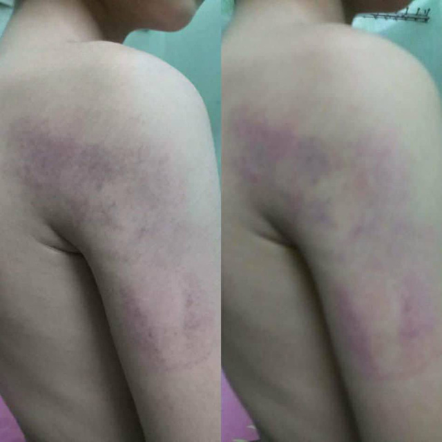 Theo lời của gia đình em T., học sinh này bị cô giáo đánh đến bầm tím. Ảnh: dantri.com.vn