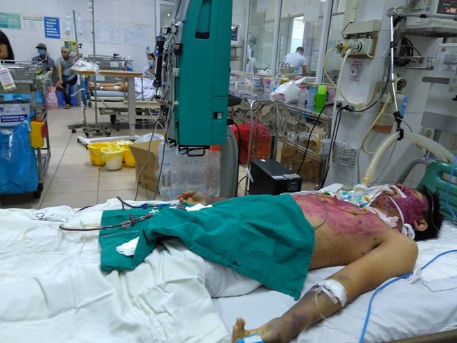 Bệnh nhân mắc thủy đậu đang được điều trị tại Bệnh viện Bệnh Nhiệt đới Trung ương. (Ảnh: PV/Vietnam+)