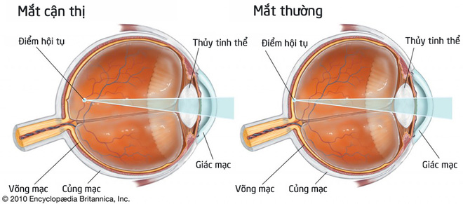 Mô hình mắt bị tật cận thị so với mắt thường (nguồn Internet).