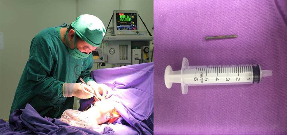 Bác sĩ Bệnh viện Sản Nhi Quảng Ninh phẫu thuật lấy đinh trong bụng của bé 9 tuổi do vô ý nuốt đinh.