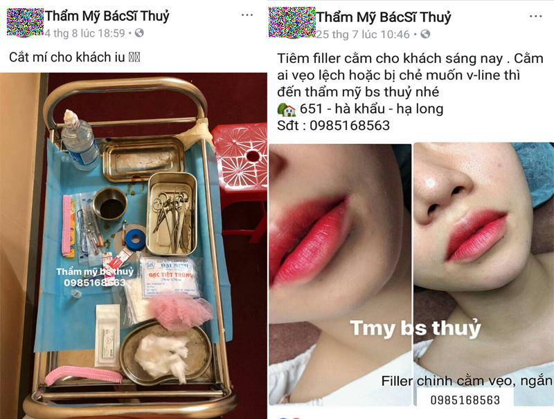 Chưa được cấp phép nhưng Cơ sở Thẩm mỹ bác sĩ Thuỷ, 651, phường Hà Khẩu, TP Hạ Long  vẫn quảng cáo thực hiện các dịch vụ cắt mí, tiêm fille cho khách hàng trên mạng xã hội.