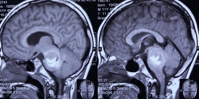 Phim chụp cộng hưởng từ khối u thân não chảy máu ở bệnh nhân.