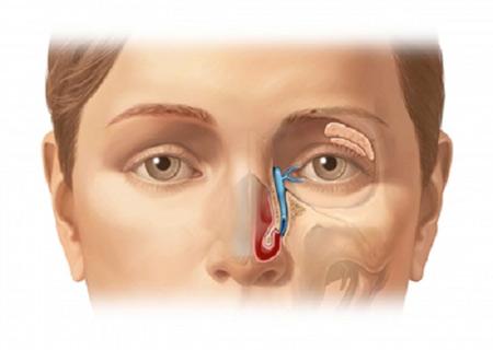 Bệnh lý mũi xoang là nguyên nhân gây biến chứng nhiễm trùng ổ mắt (ảnh minh họa)