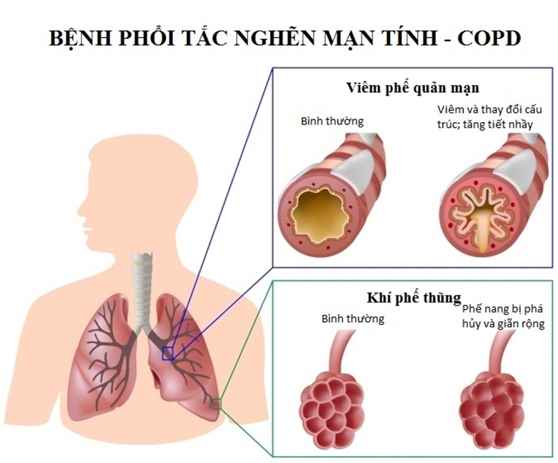 Bệnh phổi tắc nghẽn mãn tính. Ảnh: Internet