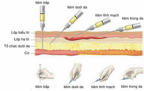 Các đường tiêm thường được áp dụng cho người bệnh.
