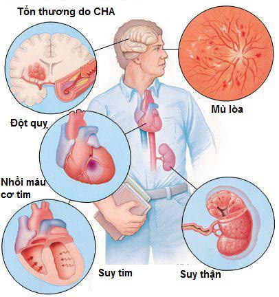 Các tổn thương có thể xảy ra do tăng huyết áp.