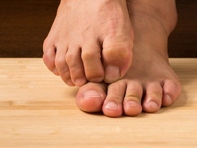 Chân tiếp xúc nhiều với nước sẽ thường xuyên khiến da bị ẩm, dễ gây nhiễm trùng ở phần khe giữa các ngón chân. Ảnh: SHUTTERSTOCK