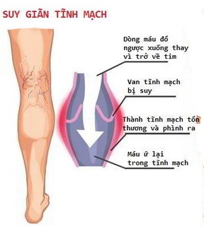 Hình ảnh suy giãn tĩnh mạch.