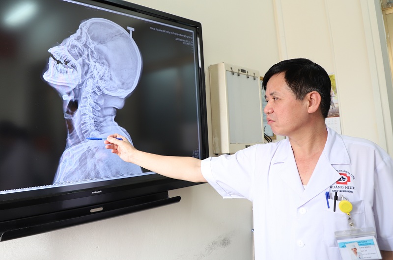 Trường hợp bệnh nhân nuốt viên thuốc còn nguyên vỏ được các Bác sĩ khoa Tai - Mũi - Họng, Bệnh viện đa khoa tỉnh xử trí kịp thời