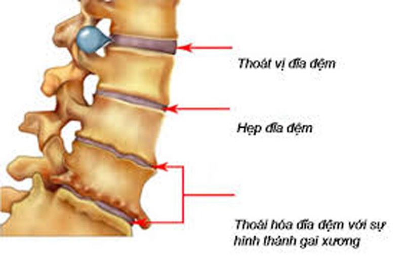 Các bệnh do thoái hoá cột sống gây đau  thắt lưng cột sống. Ảnh: theo suckhoedoisong.vn