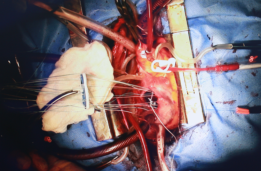 Bệnh nhân được các phẫu thuật viên thực hiện sửa van tim