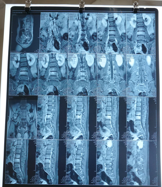 MRI xác định bệnh hiếm của bệnh nhi