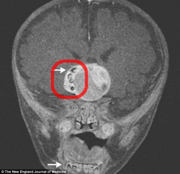 Hình ảnh chụp X-quang khối u trong não cậu bé 4 tháng tuổi.