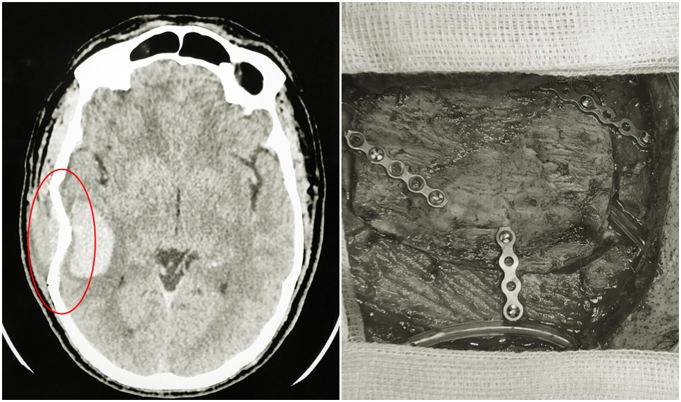 Hình ảnh sọ não bị lún vỡ được các bác sĩ phẫu thuật nẹp vít tạo hình lại hộp sọ