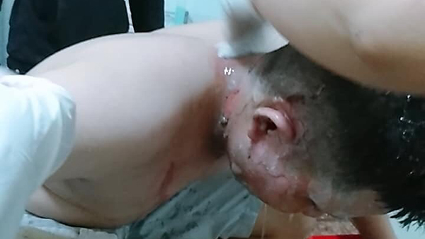  Nguyễn Chí Duy bị bỏng nặng sau vụ quăng 