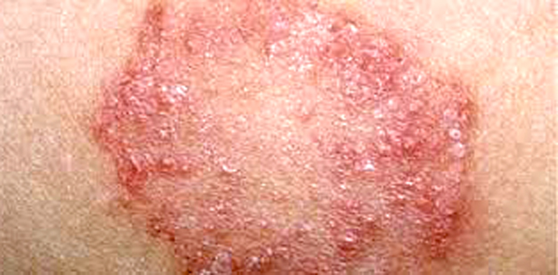  đốm đỏ hình tròn tựa đồng xu, hay hình bầu dục màu đỏ hoặc nâu xuất hiện trên da của người bệnh hắc lào (Ảnh: Trung tâm Kiểm soát bệnh tật tỉnh cung cấp)