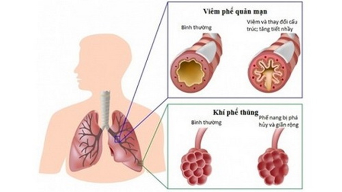 Bệnh phổi tắc nghẽn mạn tính - COPD.