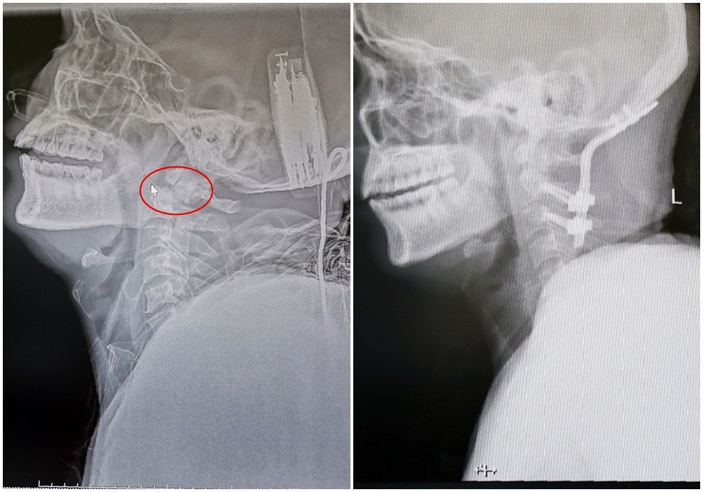 Hình ảnh tổn thương trước và sau khi thực hiện phẫu thuật cố định đốt sống cổ vào xương sọ vùng chẩm