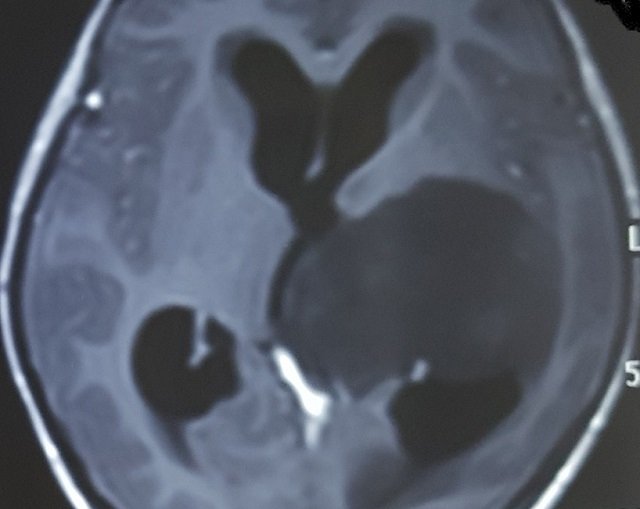 Hình ảnh phim chụp u tế bào thần kinh đệm của bệnh nhân. Ảnh:benhvienvietduc.org
