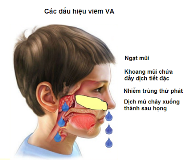 Ngạt mũi, chảy nước mũi - là những dấu hiệu của viêm VA