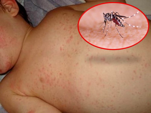 Sốt xuất huyết là bệnh truyền nhiễm cấp tính nguy hiểm do virut Dengue gây ra, truyền từ người sang người qua muỗi đốt.