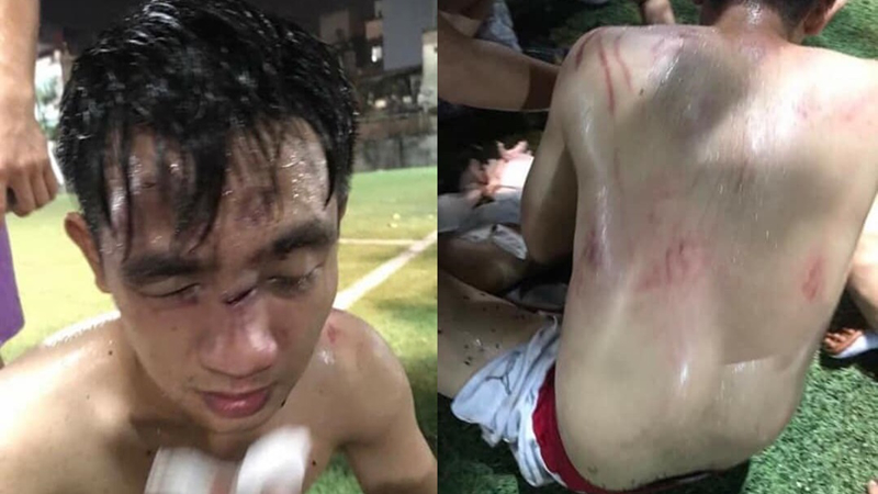  Hình ảnh nam thanh niên bị đánh bầm dập sau trận đá bóng. (Ảnh: Nguyễn Dũng)