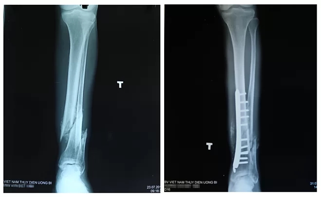 Ảnh X-quang xương chân bị lệch (hình trái) và phần xương sau khi được bác sĩ xử trí (hình phải). Ảnh: Bệnh viện Việt Nam - Thụy Điển Uông Bí
