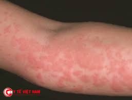 Nổi mẩn đỏ trên da là biểu hiện đặc trưng khá rõ của viêm da dị ứng.