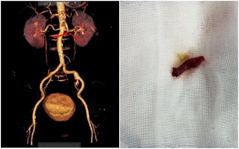 Hình ảnh chụp CLVT dựng hình đoạn mạch mạc treo bị tắc và cục huyết khối được lấy ra sau phẫu thuật.